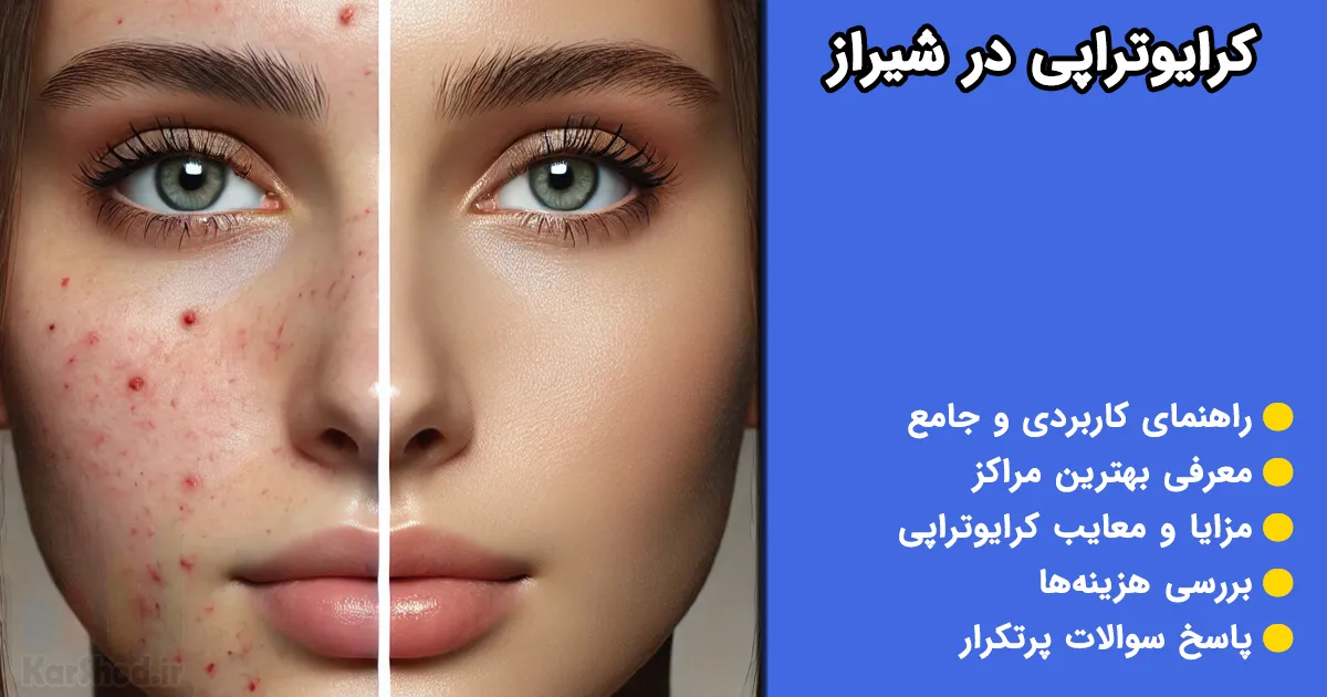 کرایوتراپی در شیراز کرایوتراپی در شیراز