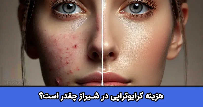 هزینه کرایوتراپی در شیراز هزینه کرایوتراپی در شیراز